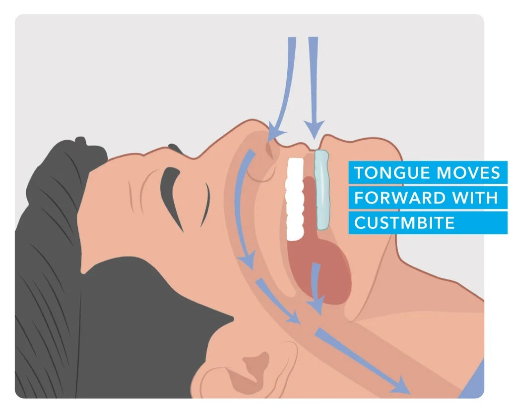 snoring system listing2 03 1800x1800 1d27ef9f e7ea 4c98 9c83 76e317d4c862